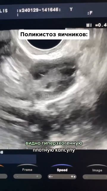 Ультразвуковая картина поликистоза яичников