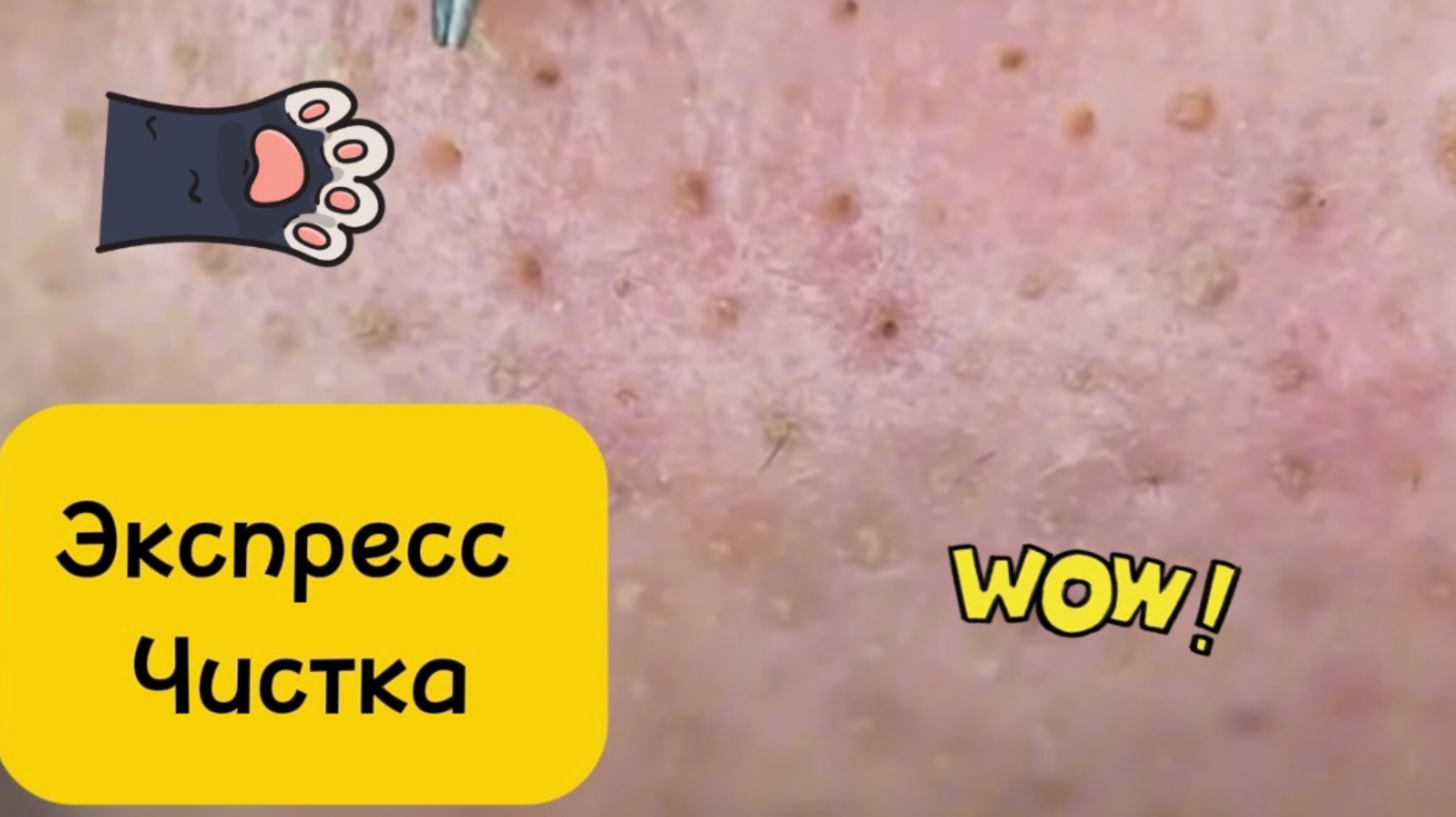 Чистка лица от угрей и акне. Выдавливание прыщей. Удаление черных точек и комедонов