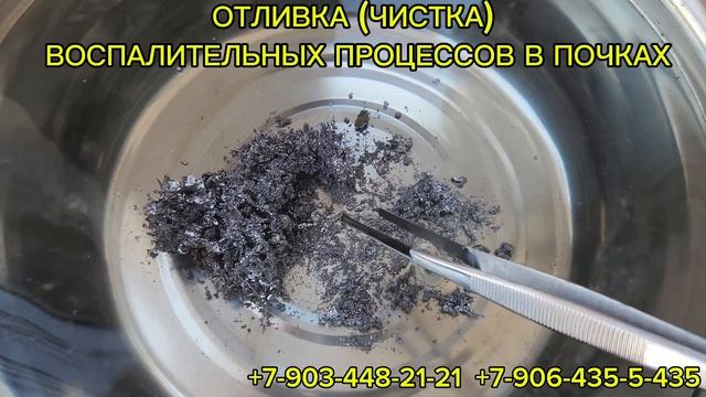 Чистка(отливка)воспаления в почках
