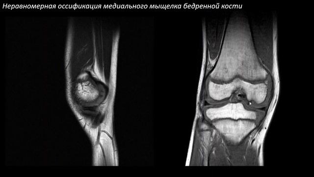 Анатомия и повреждение хряща коленного сустава и остеохондральные повреждения Учеваткин А.А Часть 2