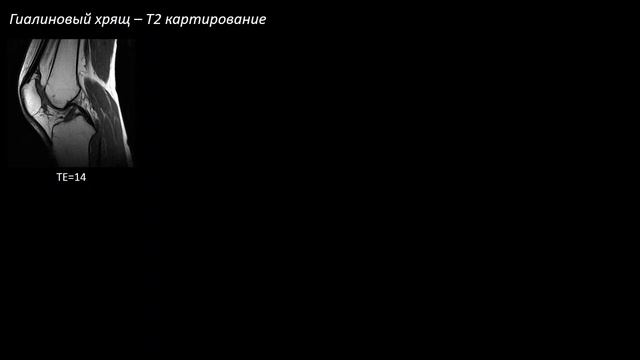 Анатомия и повреждение хряща коленного сустава и остеохондральные повреждения  Учеваткин А.А Часть 1