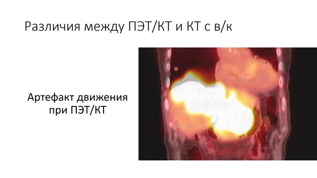 ПЭТ/КТ против КТ. Какое исследование лучше?