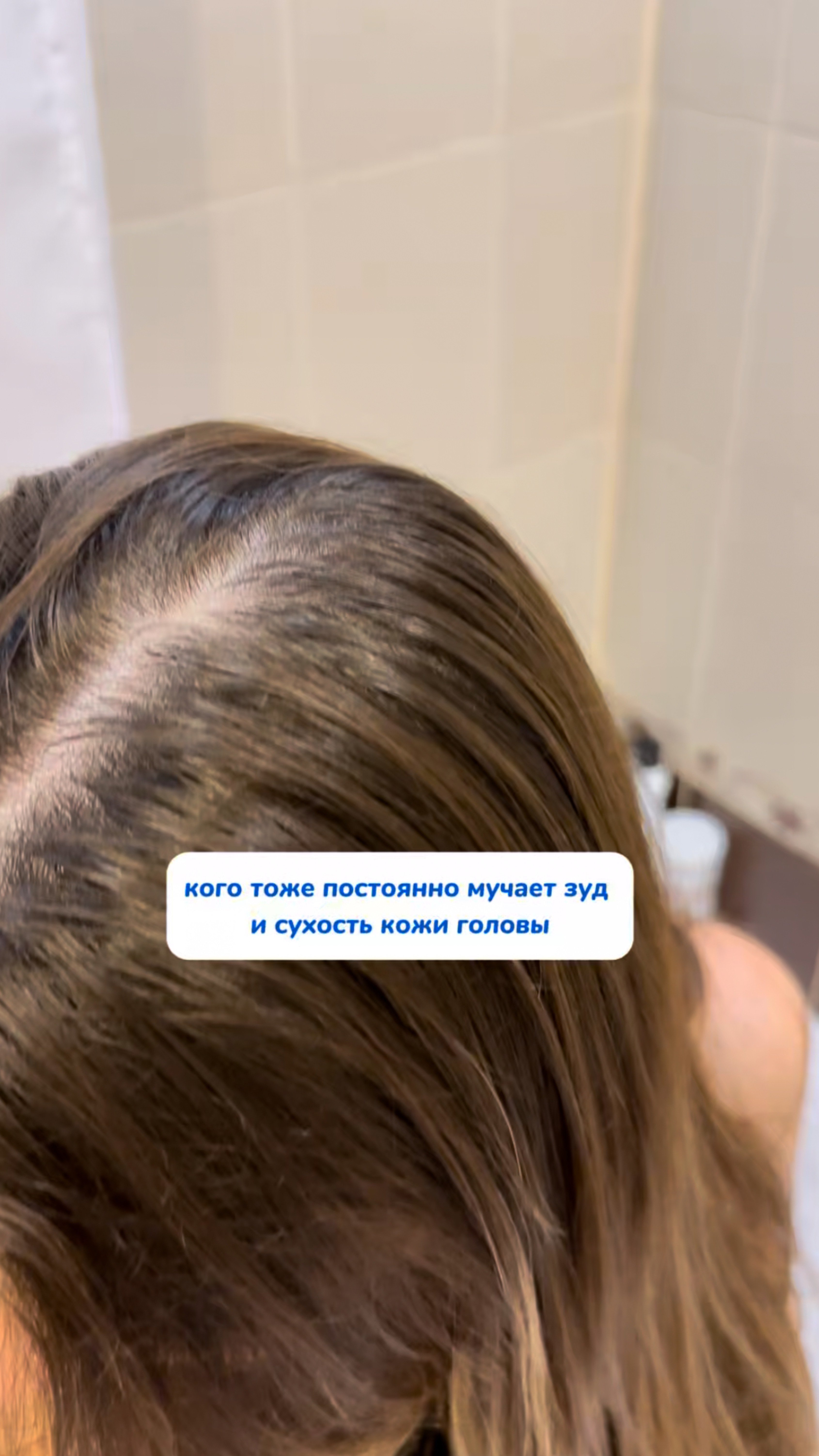 Как убрать зуд и сухость кожи головы