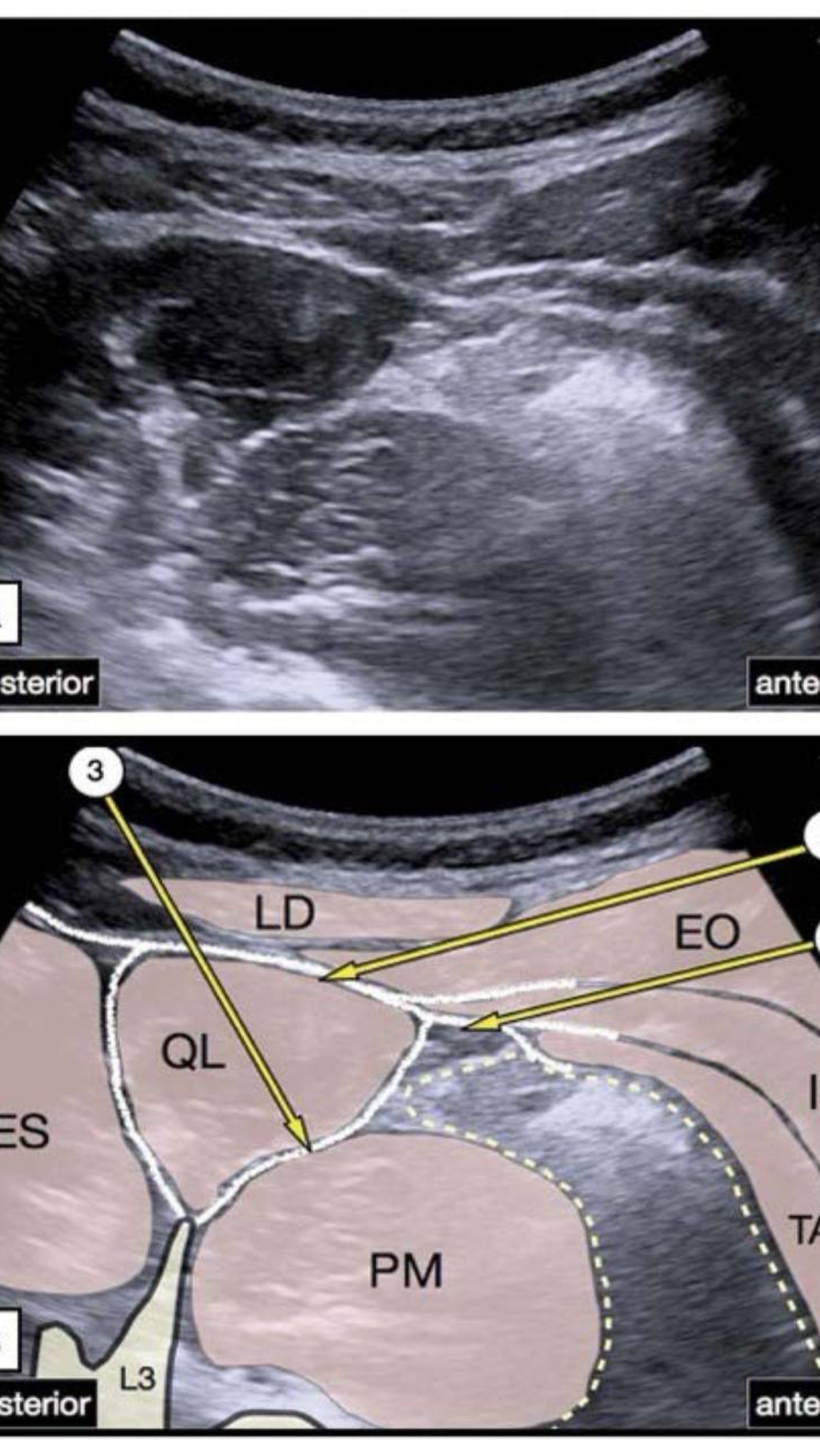 QLB-блокада  #УЗИ #навигация #anesthesiology #QLB