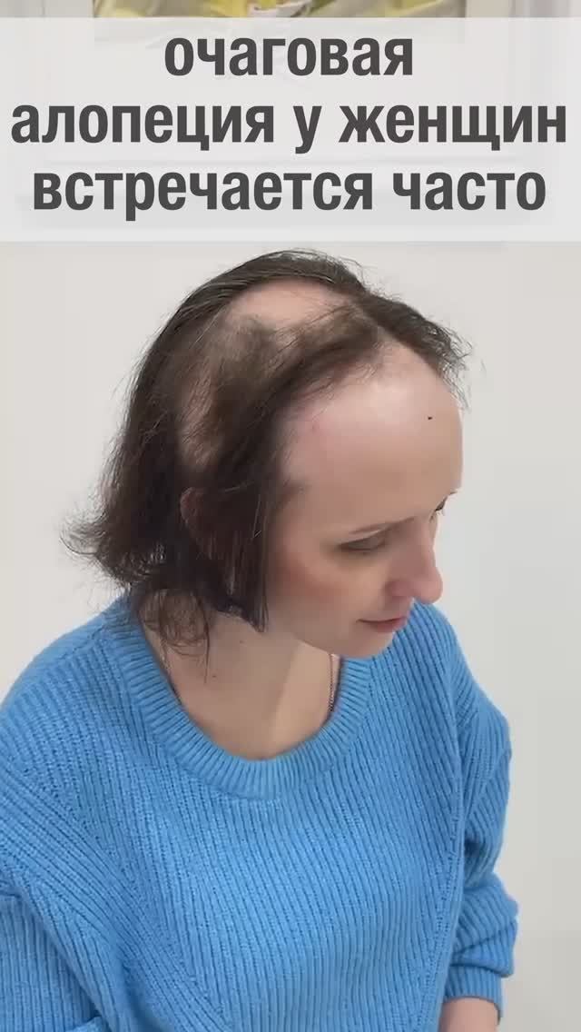 Очаговая алопеция в жизни женщины...