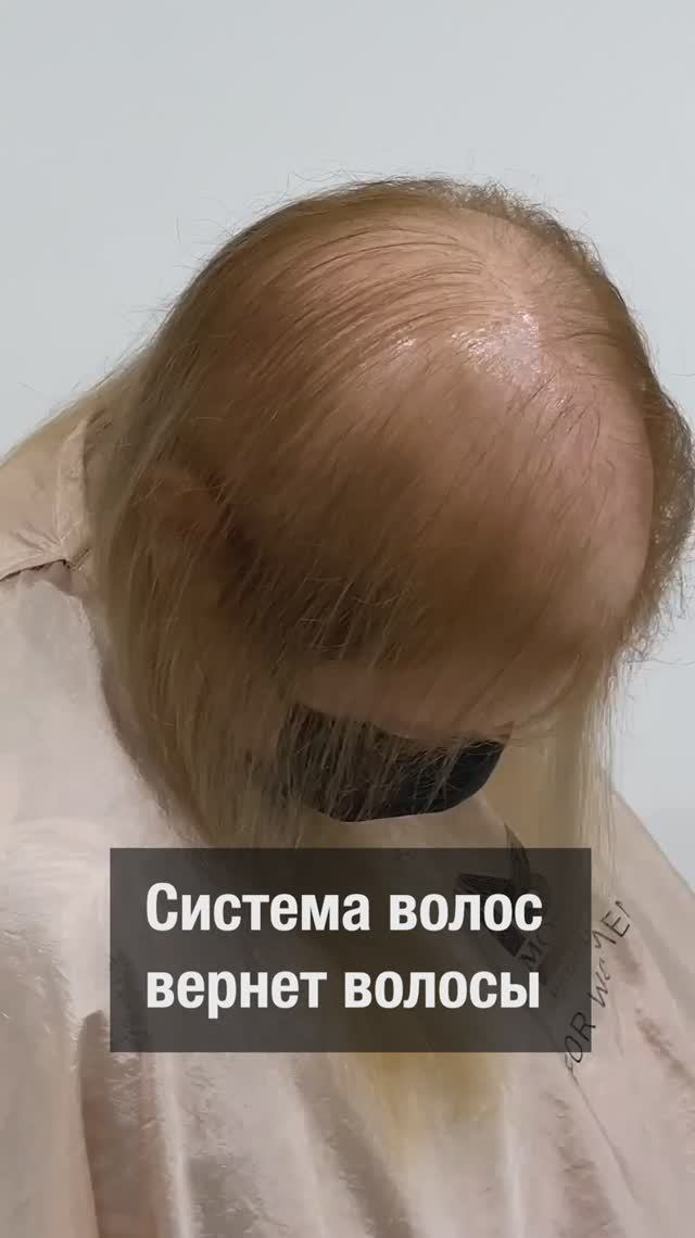 Как избежать парика при огромной алопеции?