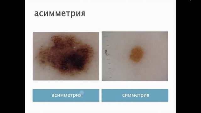 Промо лекция 4. Сысоева, меланома