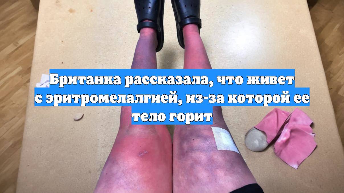 Британка рассказала, что живет с эритромелалгией, из-за которой ее тело горит