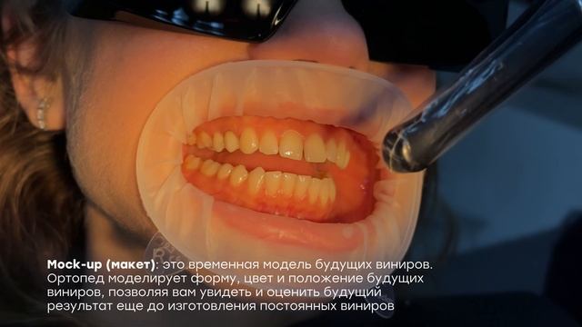 Если вы стоите на пороге принятия решения об установке виниров и не знаете, с чего начать