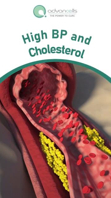 Are You at Risk for Critical Limb Ischemia?