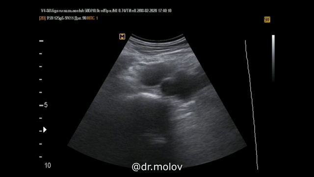 увеличенные лузлы  на УЗИ