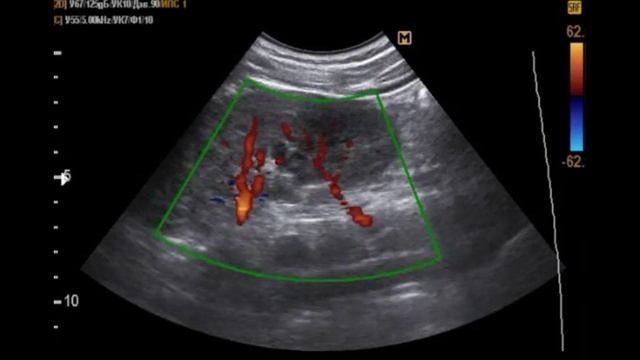 Удвоение артерий почки