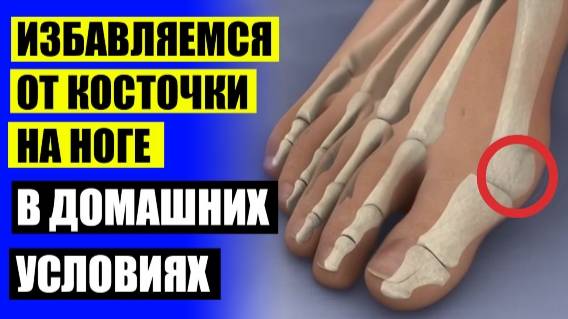 Искривление больших пальцев ног 🔥 Вальгусные шины на большой палец 🤘