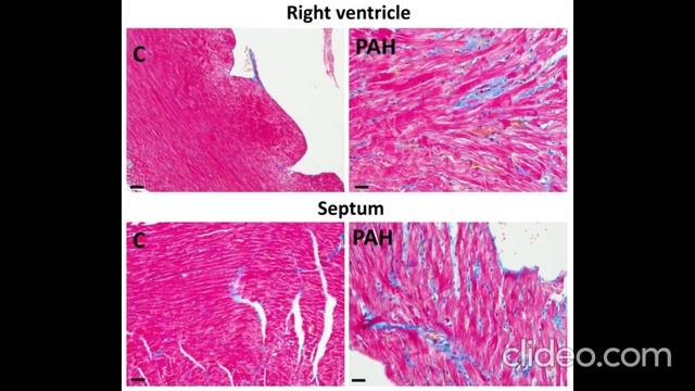 Ранолазин против аритмий при легочной артериальной гипертензии (ЛАГ), защищая коннексин-43 (Cx43)