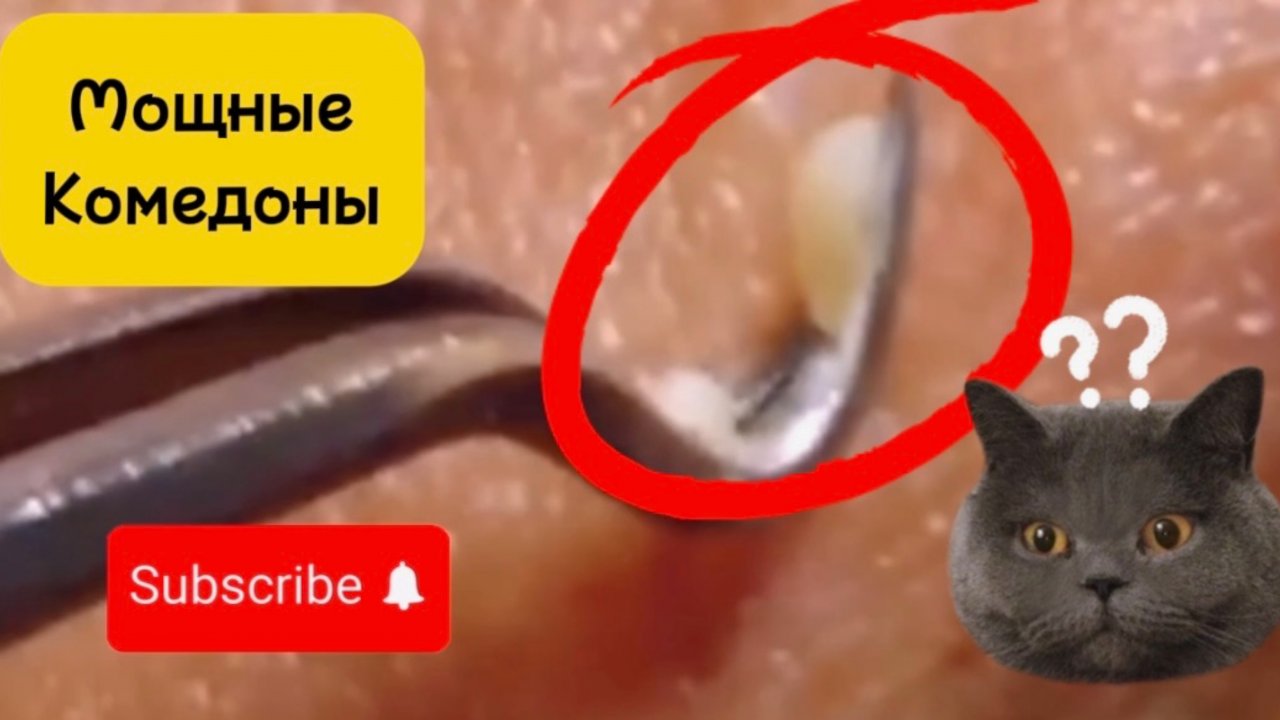 Чистка лица от угрей и акне. Выдавливание прыщей. Удаление черных точек и комедонов