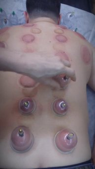 Вакуумная Терапия