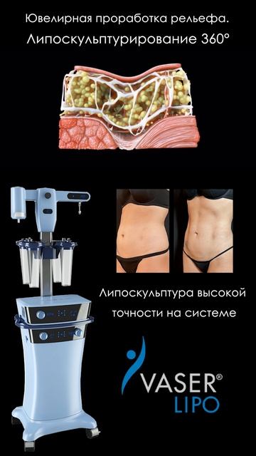 Ультразвуковая Vaser-липосакция