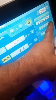 Неодимовый лазер для удаления татуировок ADSS RY580. Тест.