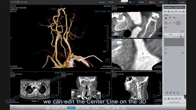 КТ-субстракционная ангиография CTDSA
