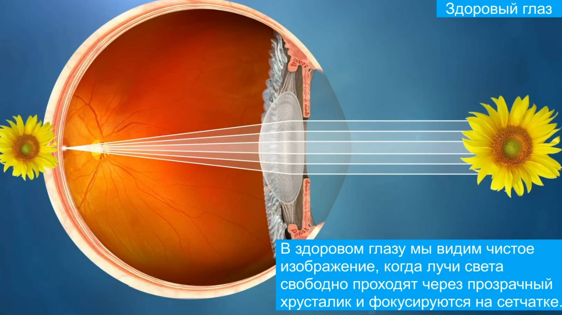 Лечение катаракты. Шаг за шагом...