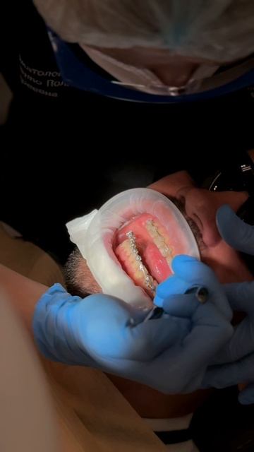 Преображение улыбки, новый образ после снятия брекет-системы