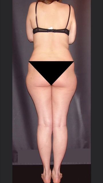 РУЧНАЯ ПЛАСТИКА ТЕЛА. КОРРЕКЦИЯ ФИГУРЫ. РЕЗУЛЬТАТ ДО И ПОСЛЕ. ВИДЕО КЛИП 10.