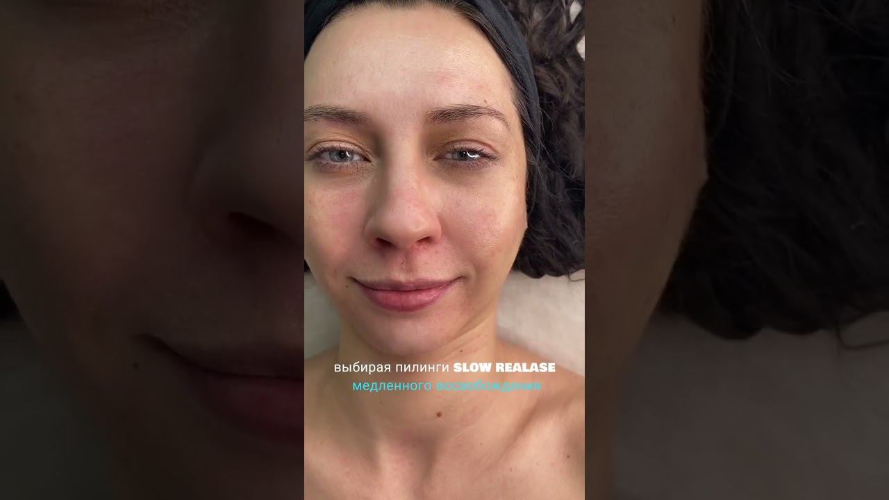 #пилинглица #татьяналексус #пилинг #пилинги #акне #beauty #косметология #морщиныналбу #botox #ботокс