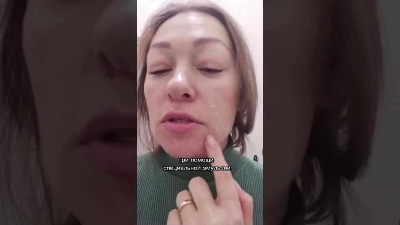 Пилинг Джесснера: #акне #уходзажирнойкожей #skincare #уходзалицом #skincareroutine #татьяналексус