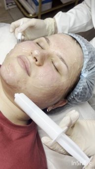 Мастер Вероники Булкина - Чистка, пилинги, Мезотерапия, Биоревитализация