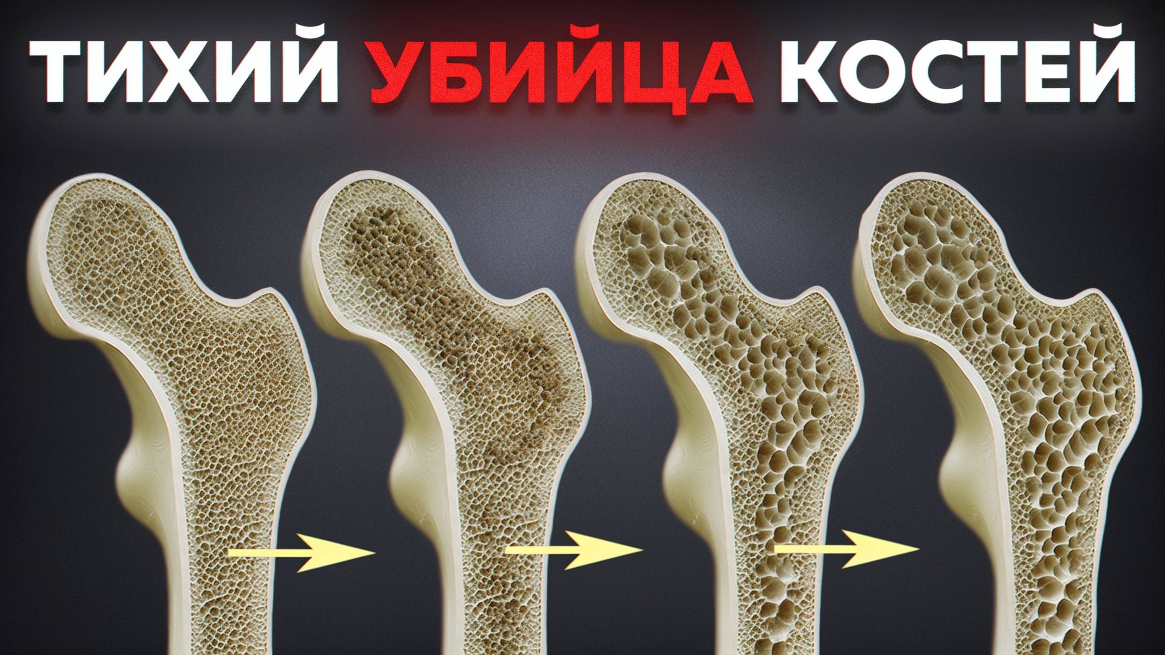 ПРИЧИНА слабых костей НЕ в дефиците кальция! / Быстрый тест на здоровье костей
