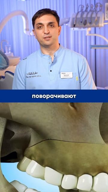 Открытый прикус