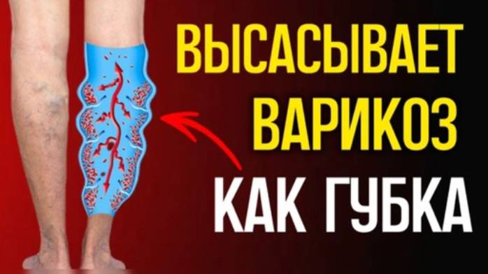 Оказывается, варикоз реально лечится! Простые средства есть у каждого дома