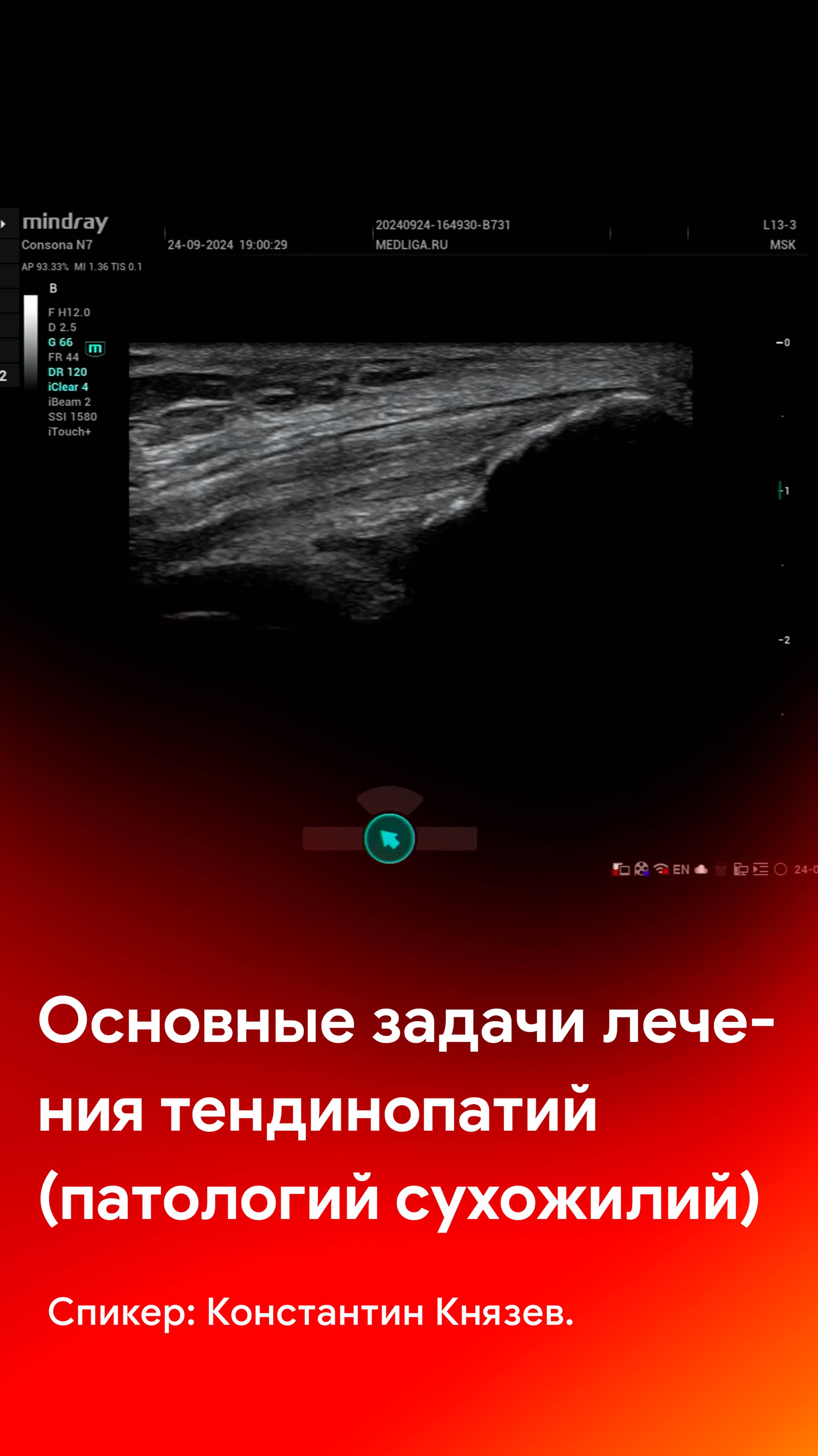 УЗИ сухожилий: основные задачи лечения тендинопатий (повреждений сухожилий)