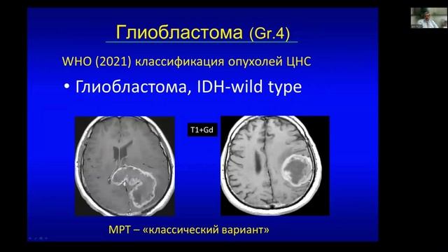 6.1 Опухоли ГМ