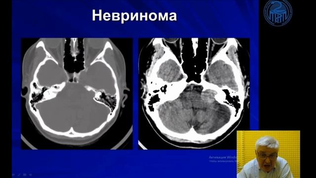 6.2 2025-09-25 Лучевая диагностика в неврологии и нейрохирургии