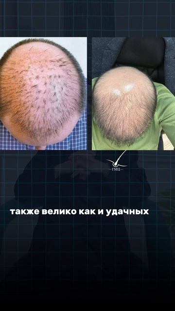 Пересадка волос в Москве за 1 день с пожизненной гарантией по договору!