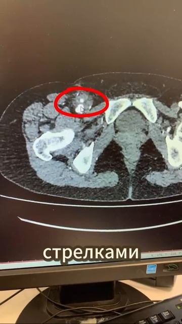 Спасение жизни в нашем городе: аневризма бедренной артерии на 3D-реконструкции