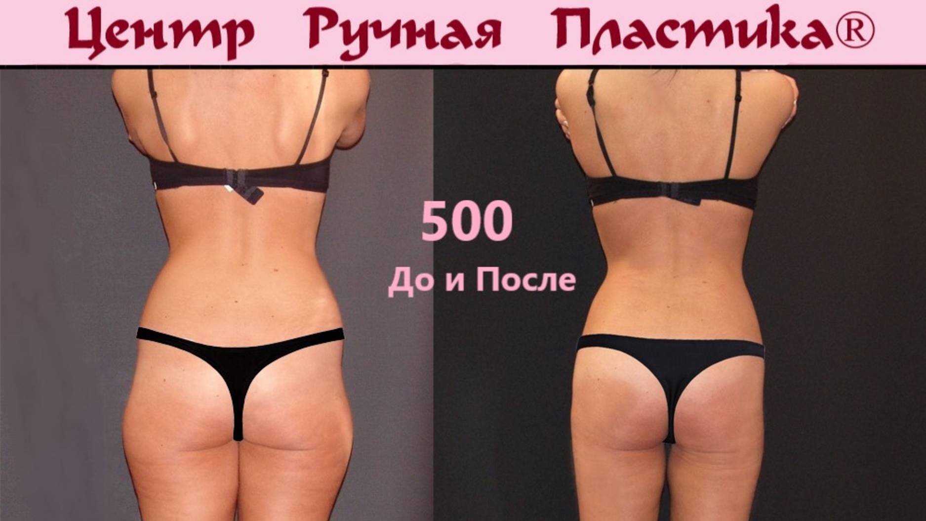 Ручная пластика тела Центр Ручная Пластика. Ручная липосакция. Ruchnaya-plastika.ru