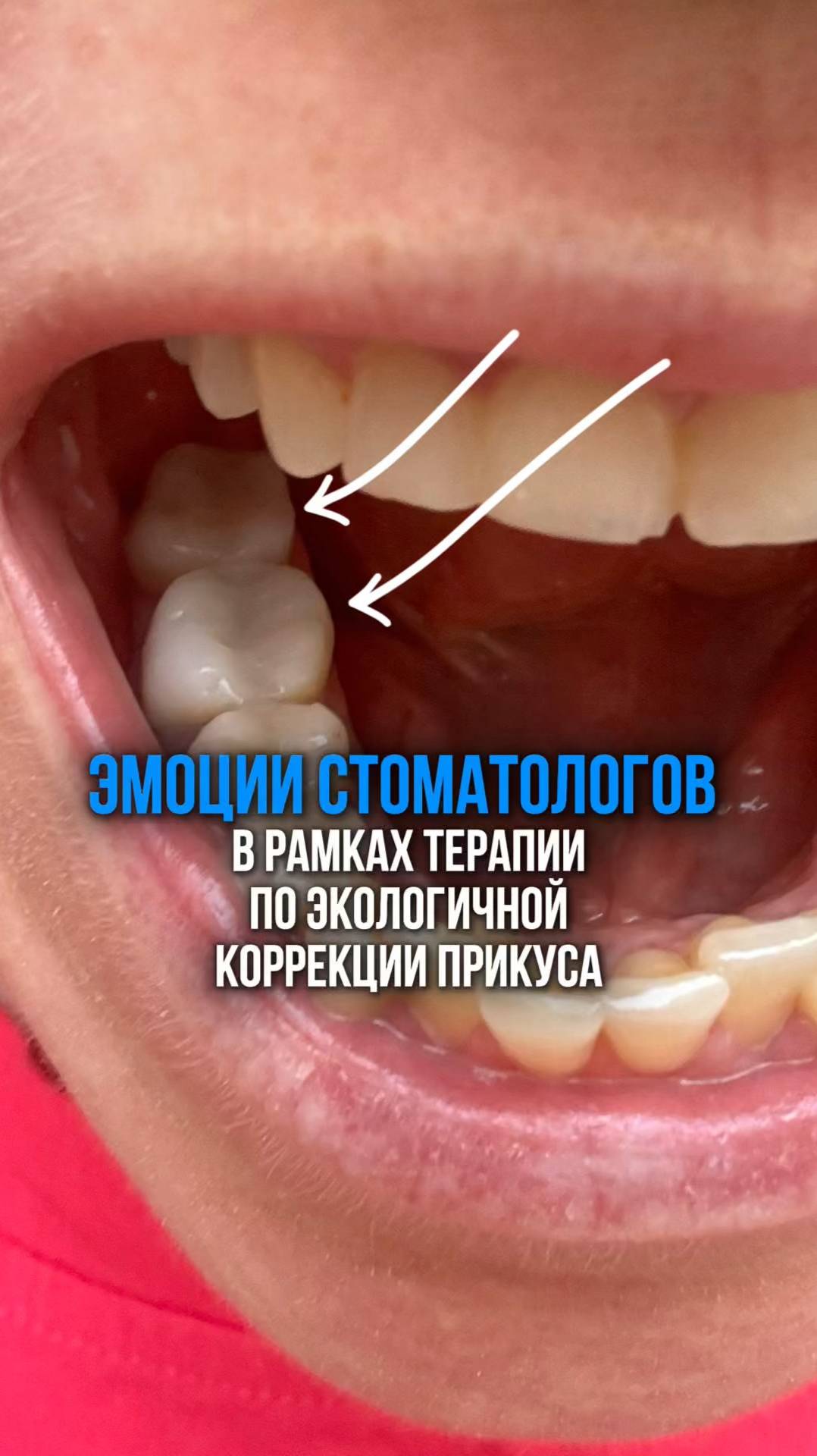 РЕАКЦИЯ СТОМАТОЛОГОВ НА НЕКЛАССИЧЕСКИЕ, НО ДЕЙСТВЕННЫЕ МЕТОДЫ ВОССТАНОВЛЕНИЯ ПРИКУСА.