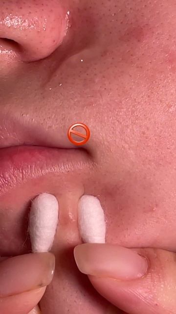 ПОДКОЖНЫЙ ПРЫЩ 😳😡 WW152207 - пилинг от черных точек 🆘 Cosmeya на WB