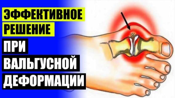 Выросла кость на ноге 🤒