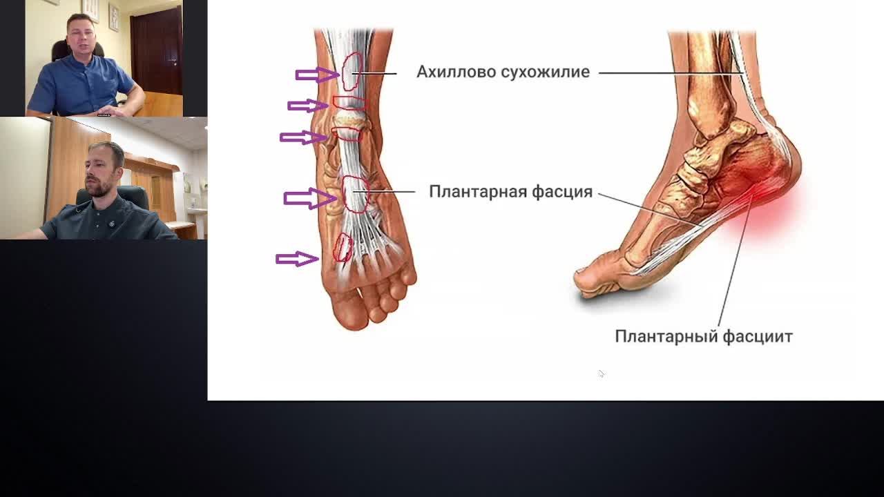 Тендинопатия! Проблема суставов - как избавиться от боли?