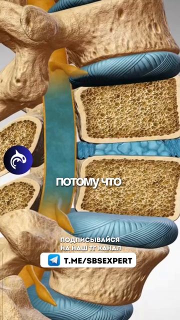 Остеопороз и как от него избавиться: сохрани и поделись с близкими #здоровье #спорт