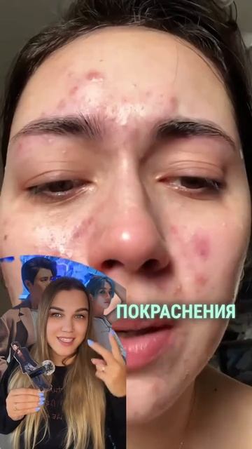 Вместо ежедневных масок, лучше используй Wb WW152229 гель от прыщей Cosmeya 🫶🏻