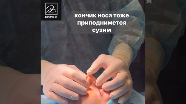 Ультразвуковая пластика носа