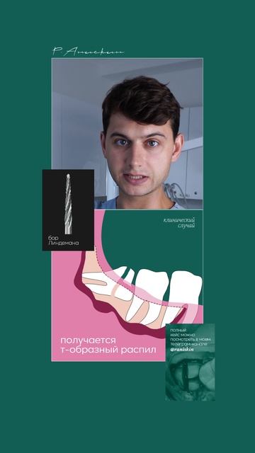 Сложное удаление зуба мудрости