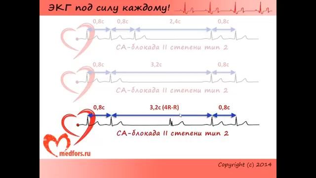 Урок 6. Видеокурс ЭКГ под силу каждому.