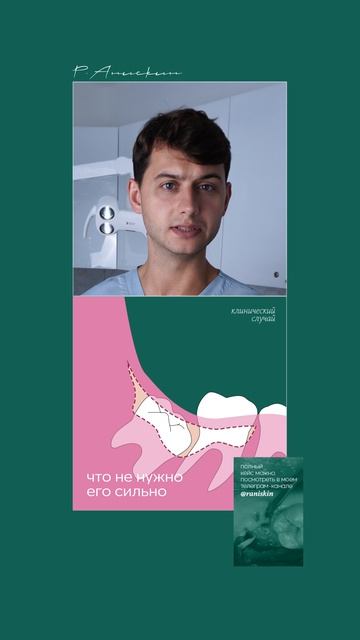 Сложное удаление зуба мудрости — среднее залегание, язычный медиальный наклон 40°