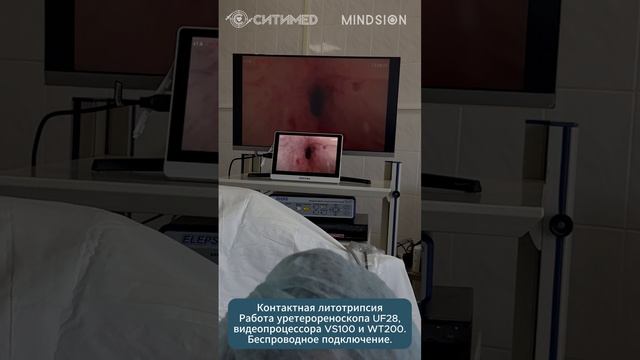 Фрагмент проведения контактной литотрипсии. Беспроводной уретерореноскоп UF28 в практике.