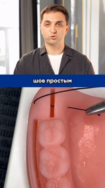 Удаление зуба мудрости